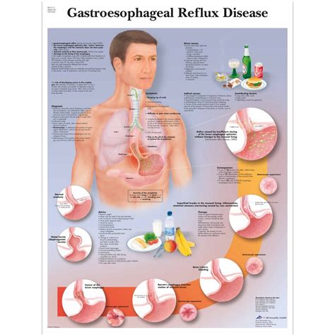 Gastroesophageal Reflux Disease Chart Gerd Sem Trainers Free Hot Nude