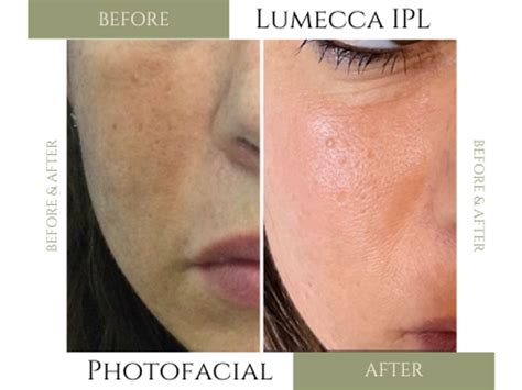 Lumecca Ipl Photofacial Questions We Got You Covered