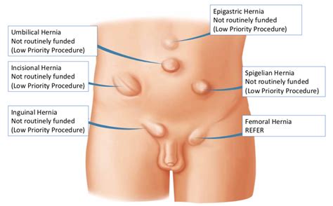 Hernia Repair Adults Inguinal Umbilical Para Umbilical