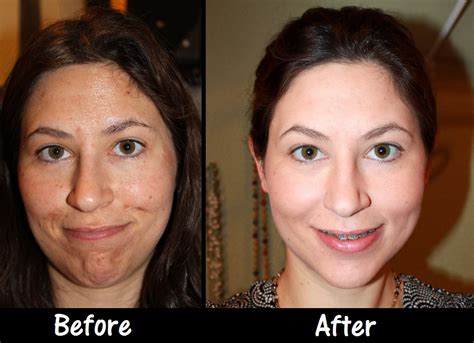 Jessner Peel Photos A Bloggers Before And After Guide To Chemical Peels