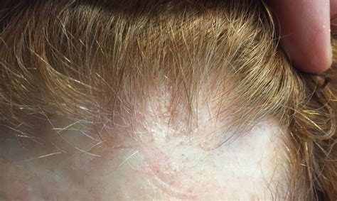 39 Awesome Rash On Back Of Head After Haircut Haircut Trends