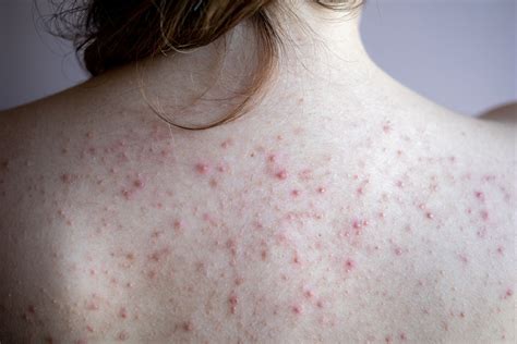 Válasz Visszaesik Szemben Red Spots On Skin Not Itchy Lusta Hamisítvány