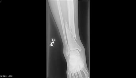 Fracture Of The Tibia Radrounds Radiology Network