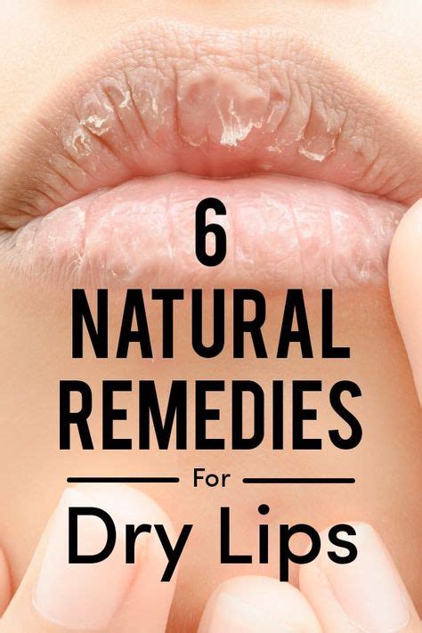 6 Natural Remedies For Dry Lips Dry Lips Natural Acne Remedies Dry