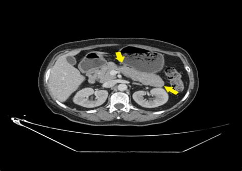 Cureus Association Of Acute Pancreatitis And Myocardial Infarction