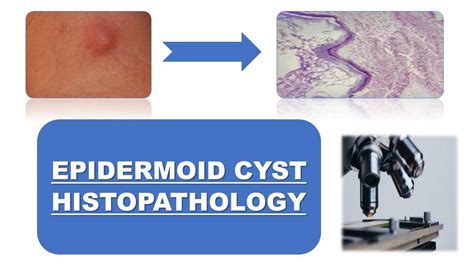 Incision And Drainage Of An Epidermoid Cyst Otosection