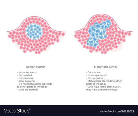 Malignant And Benign Tumor Royalty Free Vector Image