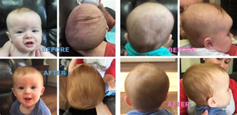 The Ultimate Guide To Plagiocephaly And Torticollis Osteopathic Healing