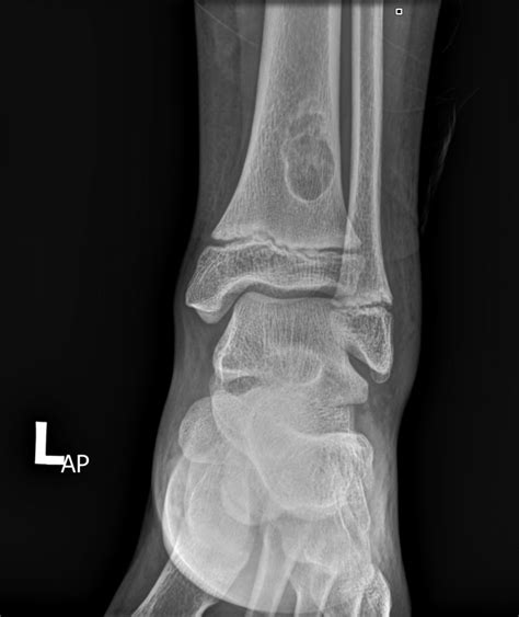 Non Ossifying Fibroma Of Distal Tibia Image