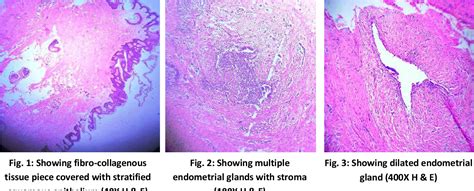 Figure 3 From Perineal Endometriosis In An Episiotomy Scar A Rare Case