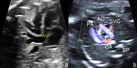 Fetal Double Aortic Arch