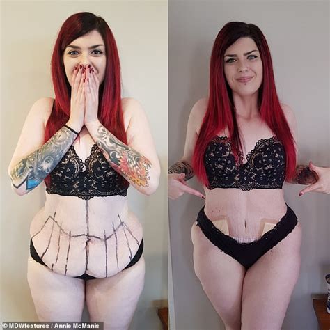 Incredible Transformation Of Woman Who Had Excess Skin Removed Daily Mail Online