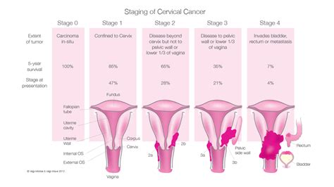 Cervical Cancer Vagi Wave