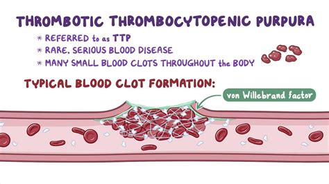 Thrombotic Thrombocytopenic Purpura Video And Anatomy Osmosis