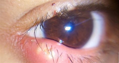 Peradangan mengenai kelopak mata bagian dalam (bagian kelopak mata yang lembab dan bersentuhan dengan mata). Mata Bengkak: Punca, Simptom dan Rawatan - The Diagnosa