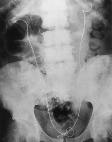 Complications Of Ureteral Stent Placement Radiographics