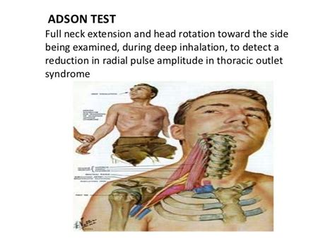 Adsons Test For Thoracic Outlet Syndrome Captions More