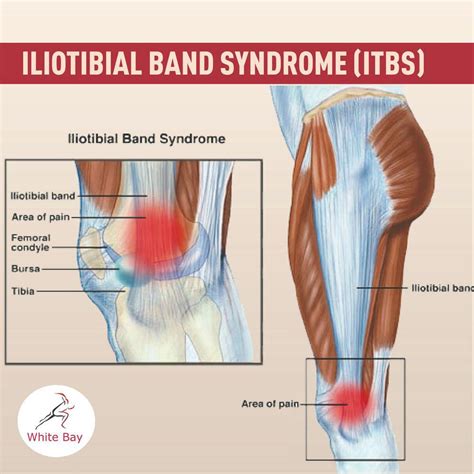 IT Band Syndrome Explained Pittsburgh Physical Medicine And