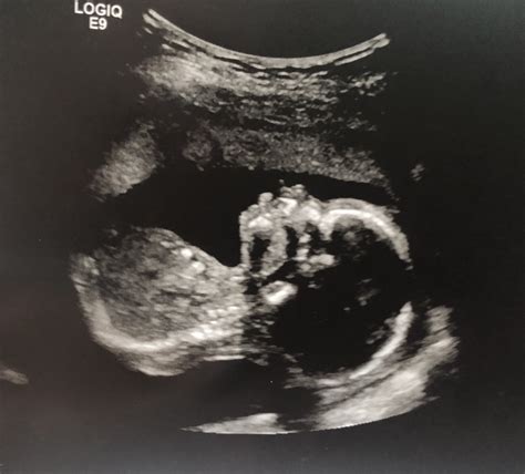 Help Cleft Lip In Ultrasound July 2019 Babies Forums What To Expect