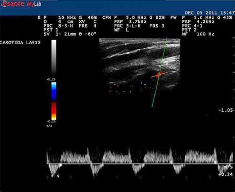 Subclavian Artery Ultrasound