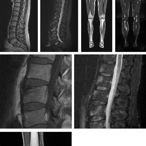 A T1 Weighted Sagittal Fast Spin Echo Sequence Repetition Time Tr