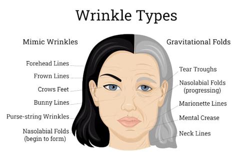 How Many Units Of Botox Do I Need For My Facial Wrinkles Saber