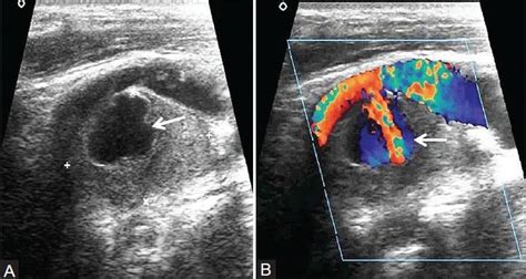 A Gray Scale And B Color Doppler Ultrasound Showing Pseudoaneurysm