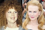 Nicole Kidman before and after plastic surgery – Celebrity plastic ...