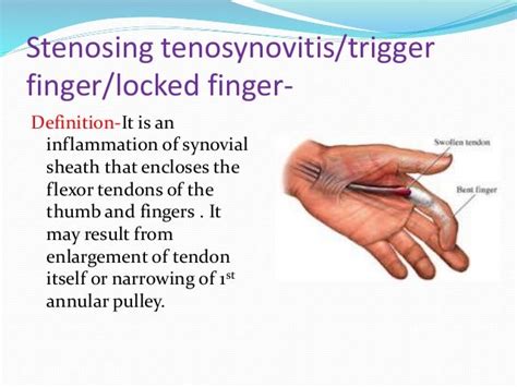 Tendinopathies Of Wrist And Hand