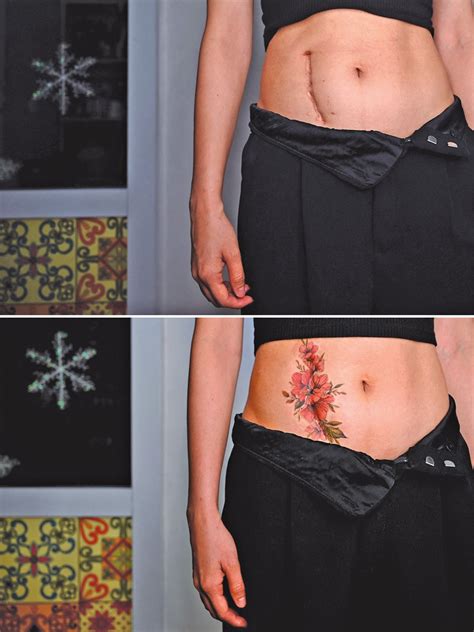 Details More Than Surgery Scar Tattoo Latest In Coedo Com Vn