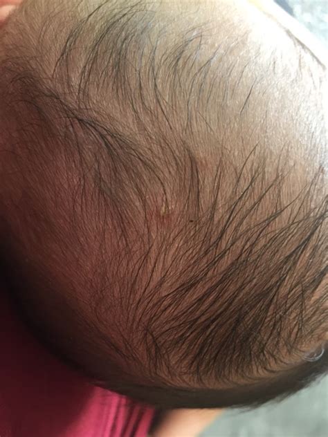 Are These Blisters On Baby Scalp Cradle Cap Help New Mom Glow