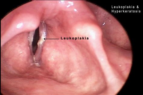 Benign Laryngeal Lesions