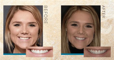 Composite Veneers Pros And Cons