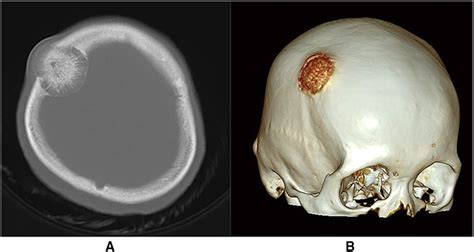 Frontiers Case Report Cavernous Hemangioma In The Right