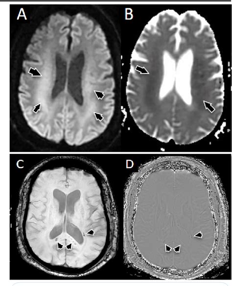 Figure 1 From Rapid Progression Of Cerebral Atrophy Associated With