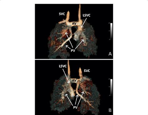 Crogtotal anomalous pulmonary venous return. Total anomalous pulmonary venous return. VR 3D ...
