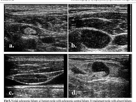 Figure From Ultrasonography Of Superficial Lymph Nodes Benign Vs My