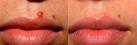 Flat Mole On Lip Removal