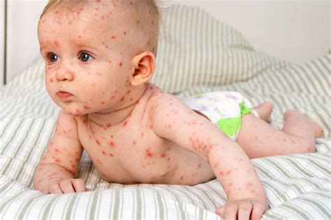 Pictures Of Skin Rashes Skin Rashes Kids Causes And Methods Of