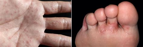 The Many Types And Causes Of Foot Blisters Blister Prevention