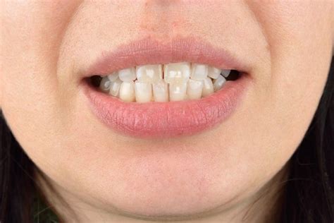 What Are Home And Clinical Remedies For White Spots On Teeth Tehran