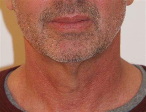 Short Scar Neck Lift Before And After Dino Elyassnia Md