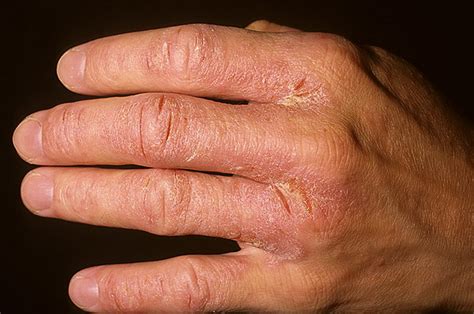 Weeping Eczema On Hands Pictures 41 Photos And Images