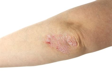 Psoriasis On Elbows Stock Image Image Of Chronic Background 41100201