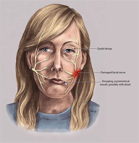 Facial Nerve And Bell S Palsy On Behance Bell S Palsy Parotid Gland