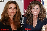 Maria Shriver Plastic Surgery Before And After Face Photos
