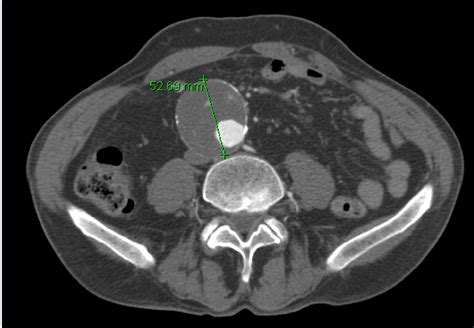 Cureus Horseshoe Kidney Isthmus Infarction After Percutaneous
