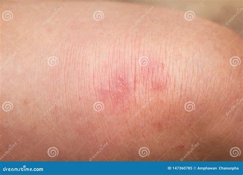Woman Has Rash On Her Knee Stock Image Image Of Medical 147360785