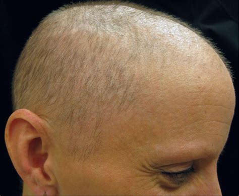 A Case Of Inflammatory Nonscarring Alopecia Associated With The