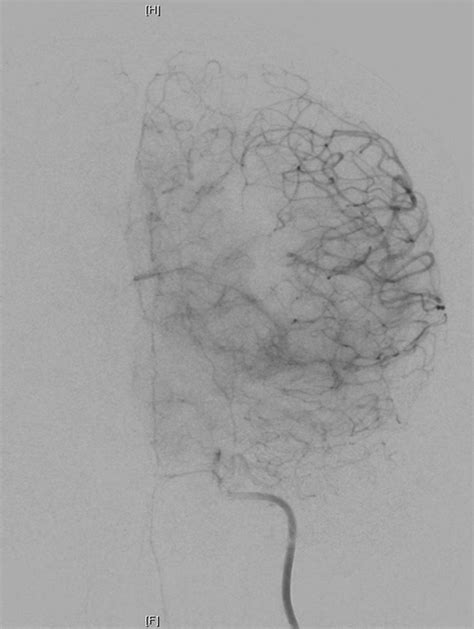 Intracranial Pseudoaneurysm After Intracranial Pressure Monitor